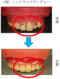 (例）ノンクラスプ